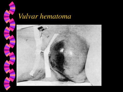 It should be suspected if the retroplacental hypoechoic zone is thickened to >2 cm 6. . Pictures of vulvar hematoma